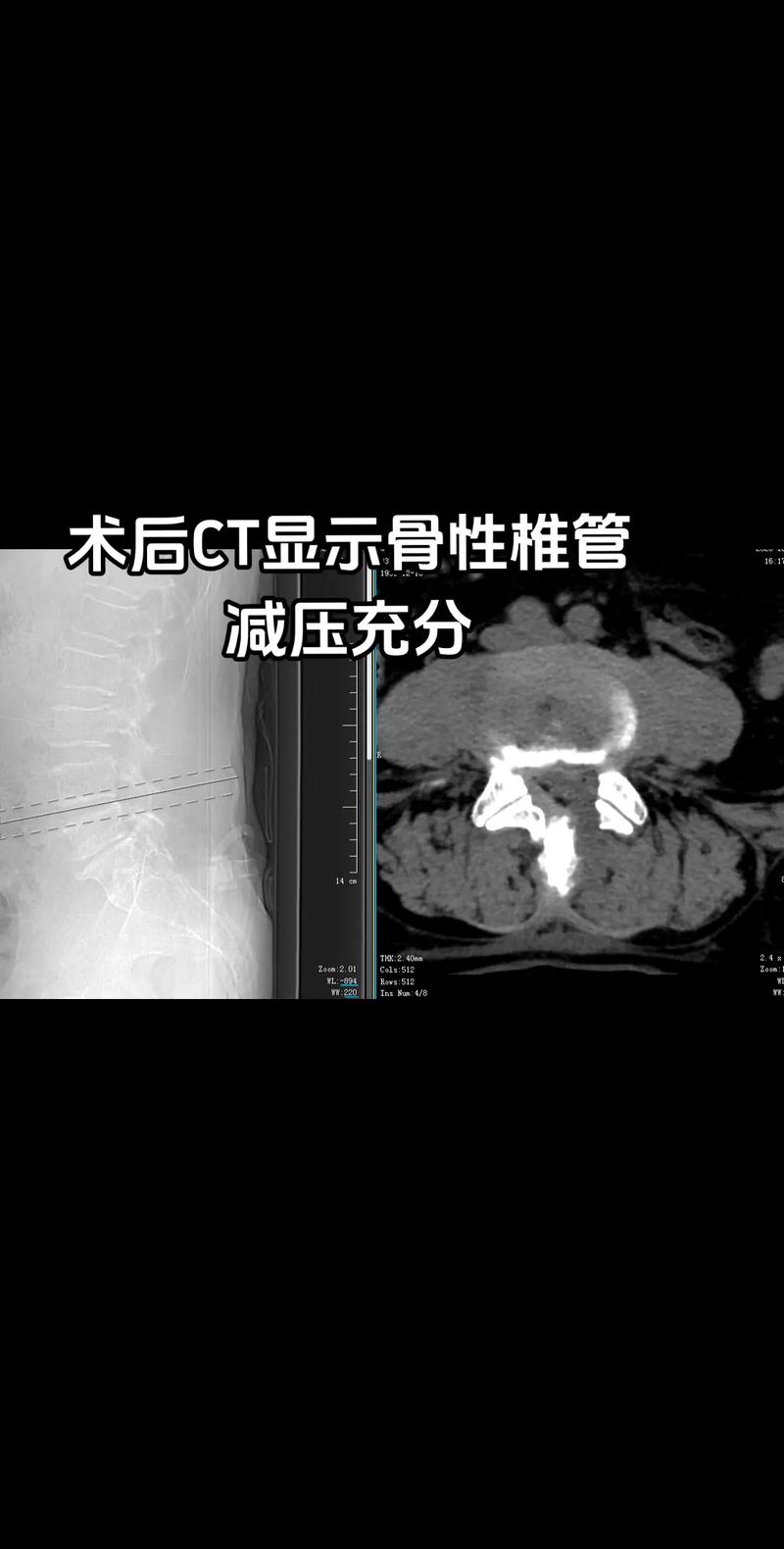 八旬老翁告别腰腿痛 UBE内镜微创治疗腰椎间盘突出合并椎管狭窄纪实