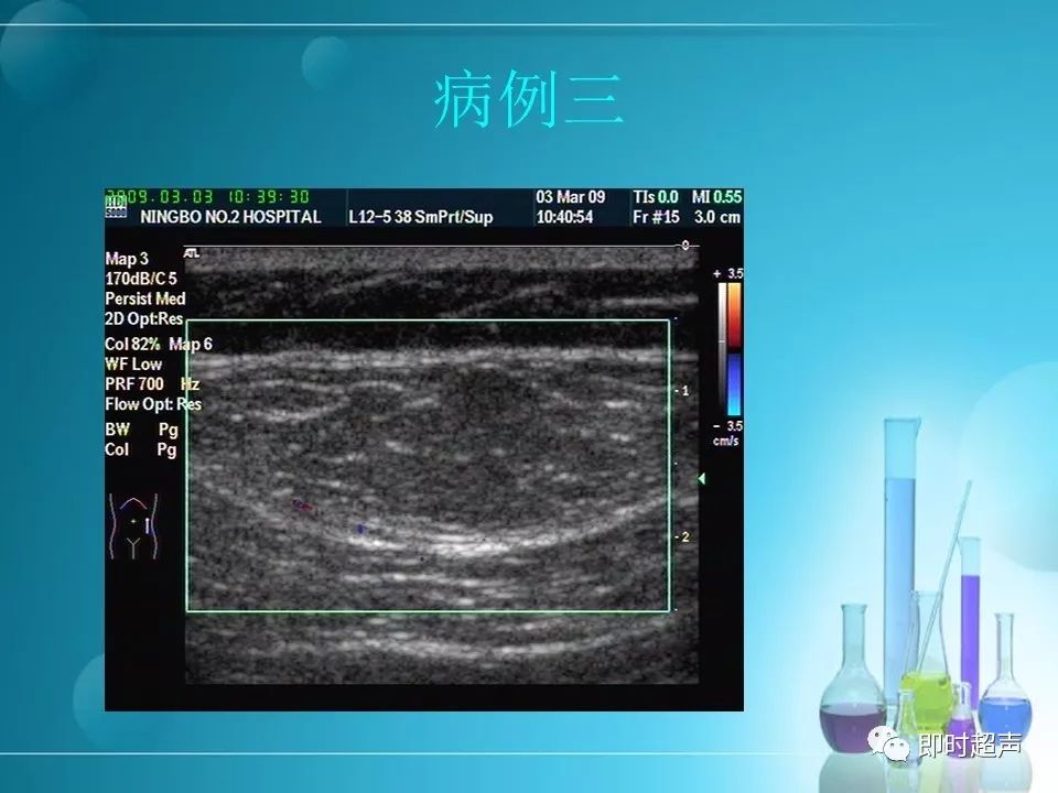超声内镜下高血管化肿块活检困境 一份教学病例分析