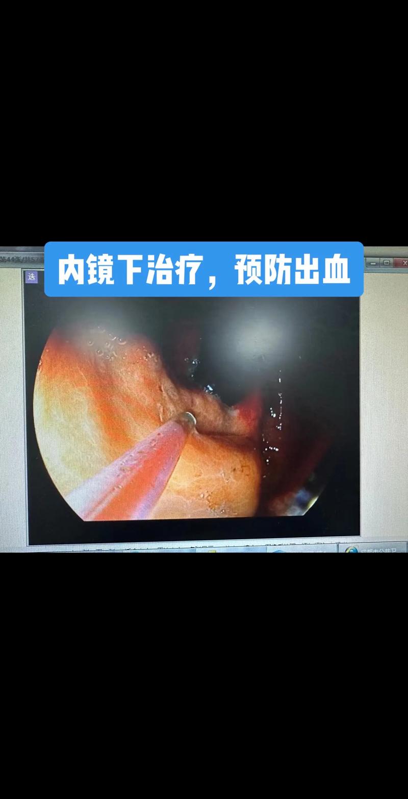 肝硬化与胃镜检查 守护消化道健康的关键一步